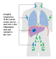 Stage 4 Hodgkin lymphoma