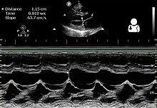 Ultrasound of peripartum cardiomyopathy[23]