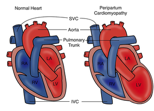 Peripartum cardiomyopathy.png