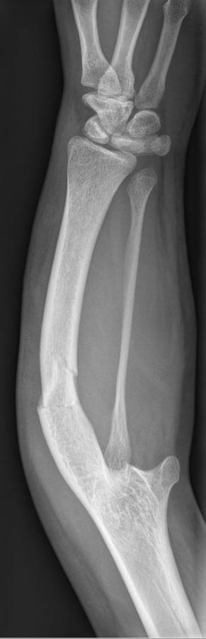 Ulnare Hemimelie mit Synostose von Humerus und Radius mit Fraktur 27M - CR ap - 001.jpg