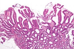 Reactive gastropathy - intermed mag.jpg