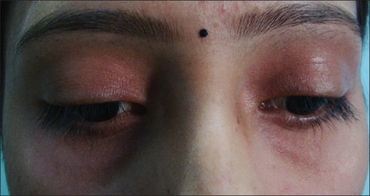 PMC3969674 IJD-59-151-g005.png