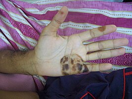 Osler lesions found on the hand and fingers of a 43-year-old male with subacute bacterial endocarditis
