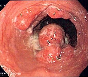 Esophageal adenoca.jpg