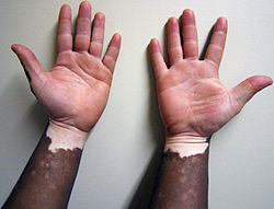 Non-segmental vitiligo on dark skin, hand facing up