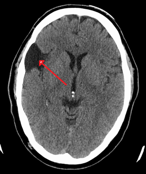 Arachnoid cyst.png