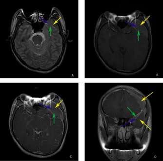 a-d)individual with complicated arachnoid cyst