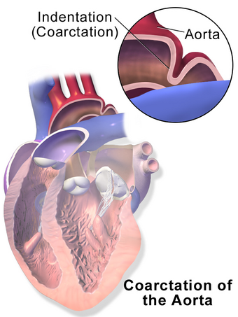 Blausen 0243 CoarctationofAorta CloseUp.png