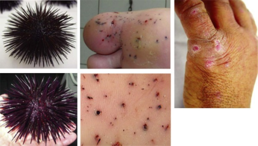 Left)Echinometra lucunter, Middle) spinesin the feet of bathers, Right) hyperkeratotic noduleson the hands