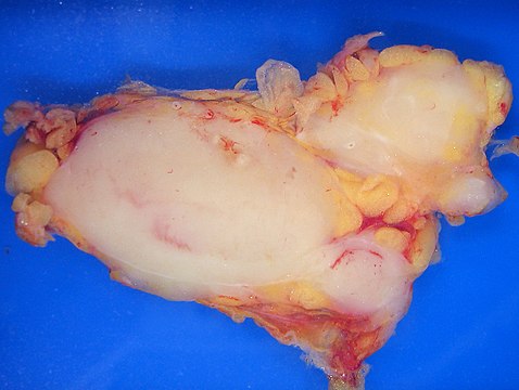 Follicular lymphoma replacing a lymph node; the bubble-like outgrowths are enlarged follicles.