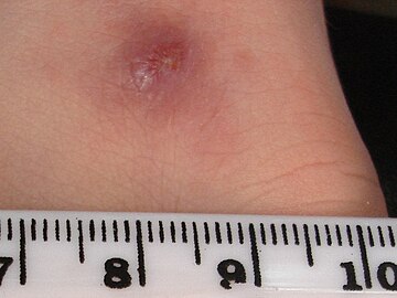 Cutaneous leishmaniasis