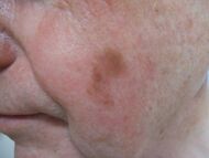 Photograph of lentigo maligna melanoma.jpg