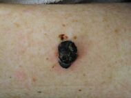 Photography of nodular melanoma.jpg