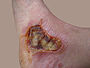 Eight day old third-degree burn caused by motorcycle muffler.