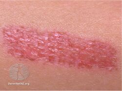 Factitious dermatitis
