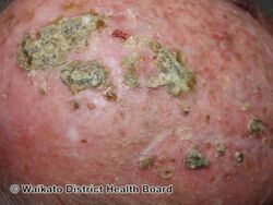 Erosive pustular dermatitis of the scalp