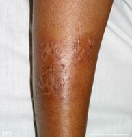 Asteatotic dermatitis