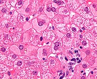 Ground glass hepatocytes