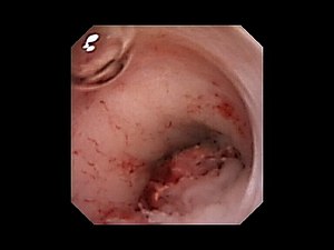 Cystoscopy - Uretereal Cancer.jpg