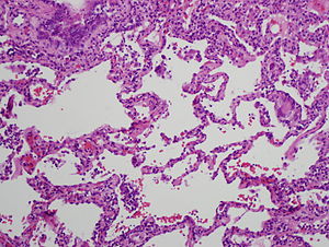Histology of chronic hypersensitivity pneumonitis.jpg