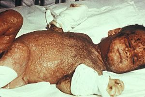 Eczema vaccinatum infant.jpg