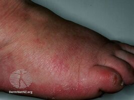 Idiopathic plantar hidradenitis