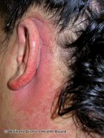 Contact allergic dermatitis