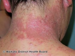 Contact allergic dermatitis
