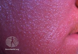 Contact allergic dermatitis