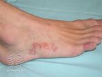 Cutaneous larva migrans (DermNet NZ arthropods-larva-mig2).jpg