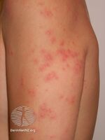 Swimmers itch (DermNet NZ arthropods-swimmer1).jpg