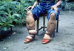 Elephantiasis of the legs due to filariasis. Luzon, Philippines.