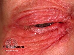 Severe acute eyelid dermatitis