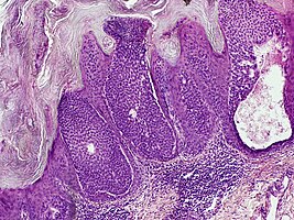 Poroma eccrinale (hidroacanthoma simplex)