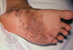 Mycetoma foot (DermNet NZ mycetoma-foot).jpg