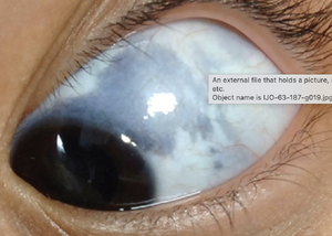 Ocular melanocytosis.png