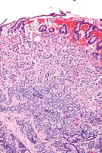 Gastric neuroendocrine tumour - intermed mag.jpg
