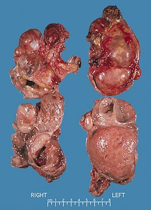 Bilateral pheo MEN2.jpg