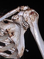 3-D CT reconstruction of Bankart lesion which occurred post anterior shoulder dislocation.jpg