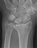 Chauffeur-Fraktur und PSU bei Ulnavorschub mit Impaktation 83W - CR ap - 001.jpg