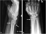 Colles fracture1.png