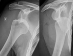 Dislocated shoulder X-ray 03.png