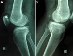 Hoffa fracture of medial unicondylar and bilateral in a man a rare case 2015 P03.png