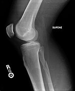 Maisonneuve fracture Fibula.JPG