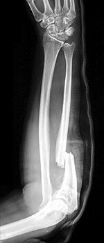 Monteggia Fracture.jpg