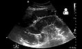 Small bowel obstruction on ultrasound.[15]