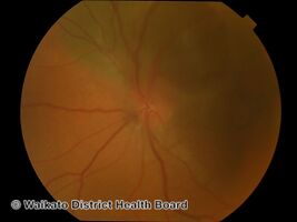 Uveal-choroidal melanoma (DermNet NZ lesions-w-uveal-melanoma2).jpg