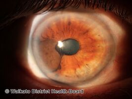 Uveal-iris melanoma (DermNet NZ lesions-w-uveal-melanoma5).jpg