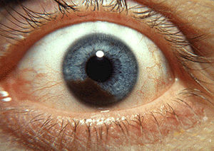 Iris melanoma.jpg