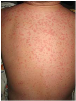 Viral exanthem
